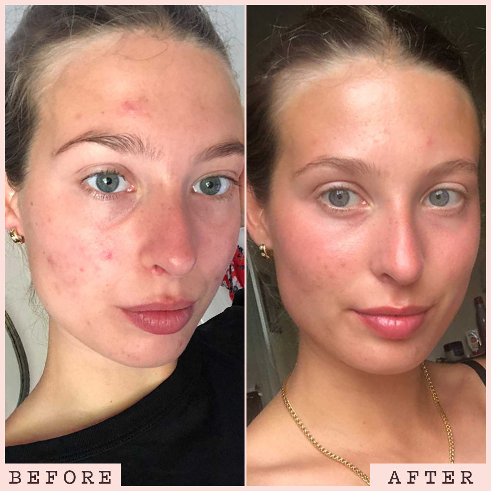 Charcoal Face Mask Calming Face Mask For Acne frank body