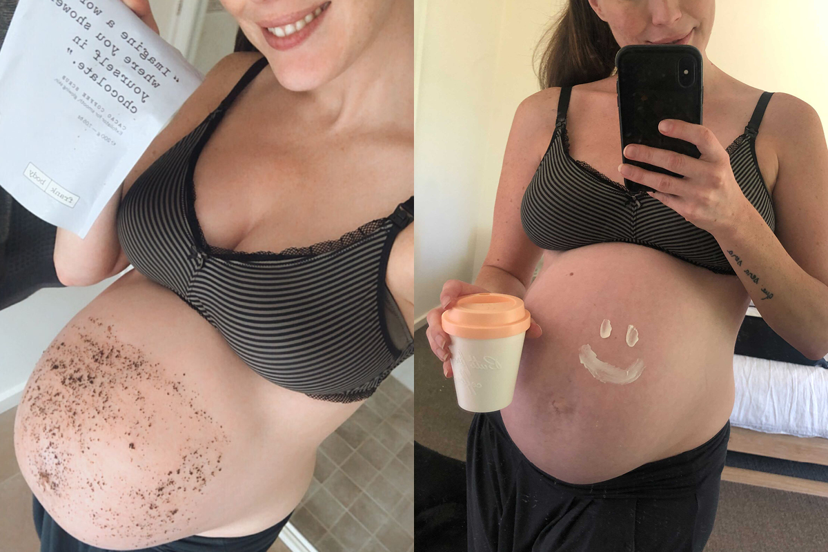 How can you make stretch marks after pregnancy go away?